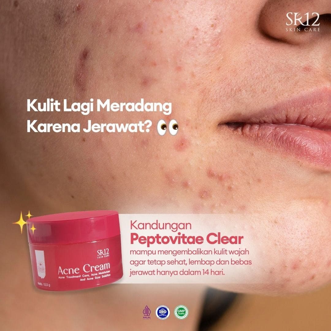 Acne Cream